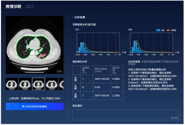 百度「AI战疫」：首次开源肺炎CT影像分析模型，让诊断从分钟到秒