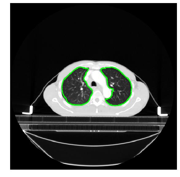 百度「AI战疫」：首次开源肺炎CT影像分析模型，让诊断从分钟到秒