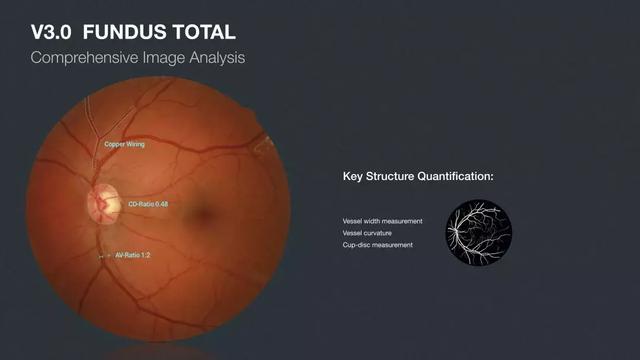 一眼万年：AI眼底筛查为什么能够成为AI医疗中的“落地之王”