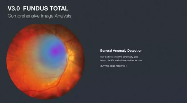 一眼万年：AI眼底筛查为什么能够成为AI医疗中的“落地之王”
