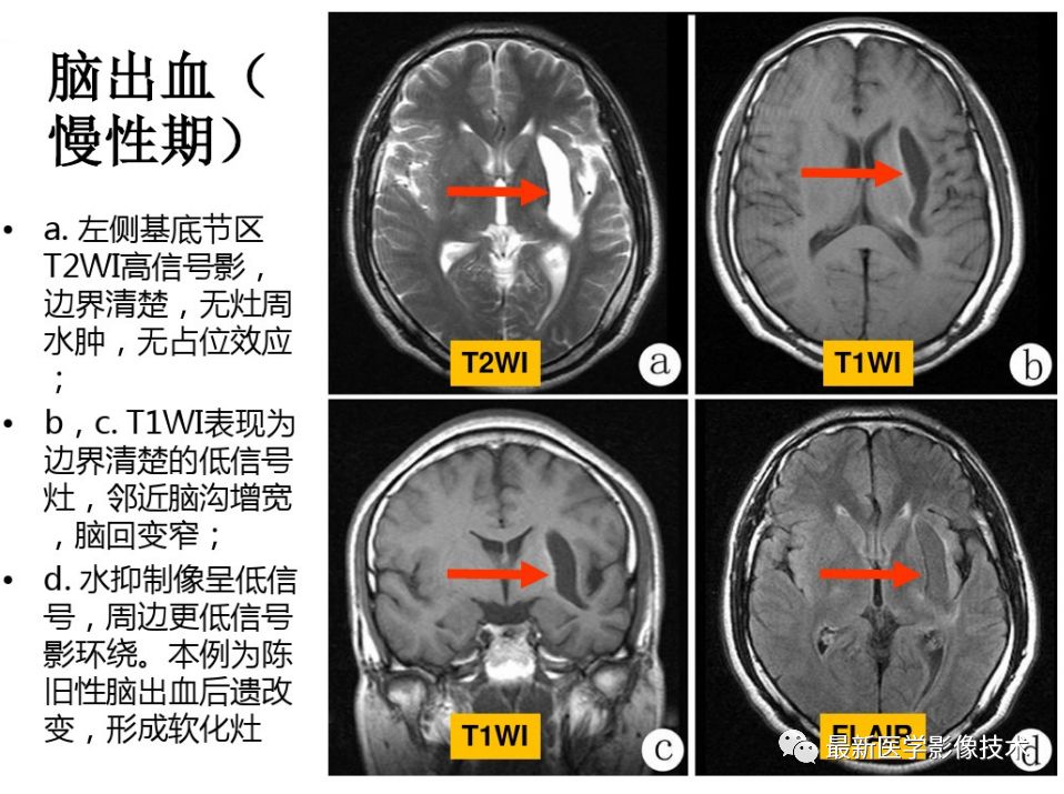 脑血管疾病在MRI影像上的表现是什么