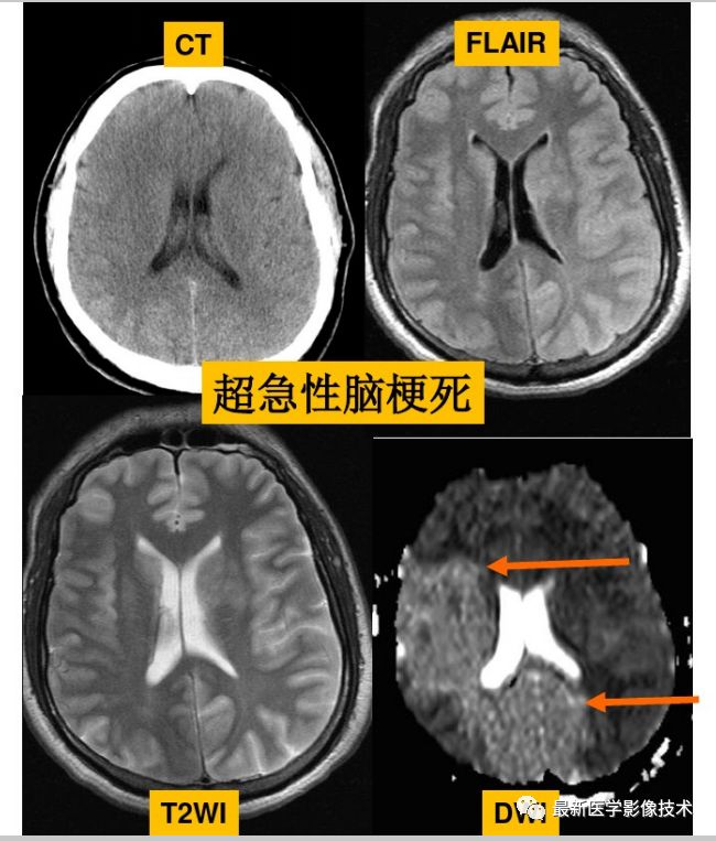 脑血管疾病在MRI影像上的表现是什么