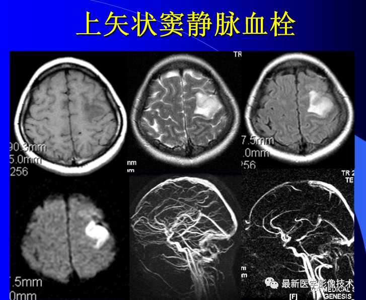 脑血管疾病在MRI影像上的表现是什么