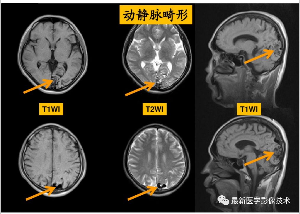 脑血管疾病在MRI影像上的表现是什么